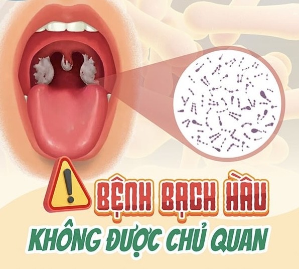 Bạch hầu là bệnh gì, vì sao có thể tử vong trong vài ngày? - Ảnh 2.