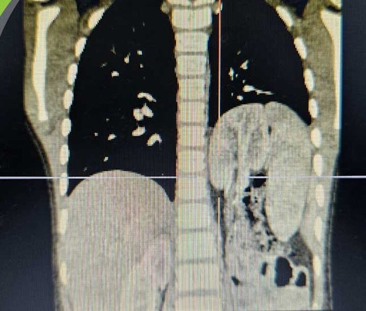 Bé trai nguy kịch do nội tạng chui lên lồng ngực- Ảnh 1.