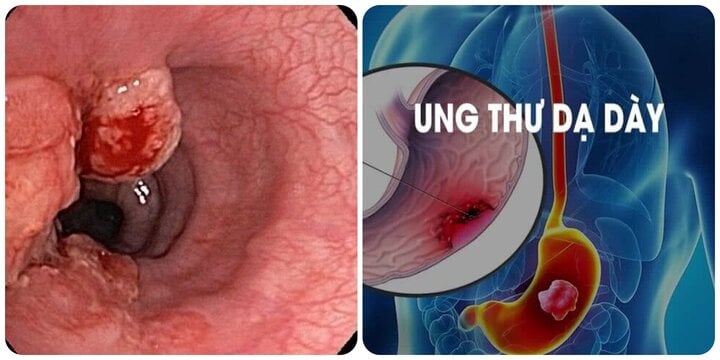 7 dấu hiệu ung thư dạ d&agrave;y thường gặp nhất kh&ocirc;ng n&ecirc;n bỏ qua- Ảnh 1.