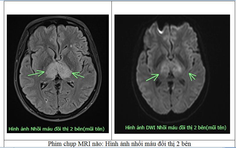 Người phụ nữ Phú Thọ suýt mất mạng vì đột quỵ: Cảnh báo 1 thói quen nhiều người Việt hay làm khi đau đầu- Ảnh 1.