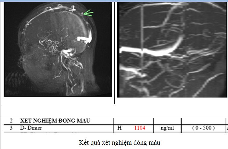 Người phụ nữ Phú Thọ suýt mất mạng vì đột quỵ: Cảnh báo 1 thói quen nhiều người Việt hay làm khi đau đầu- Ảnh 2.