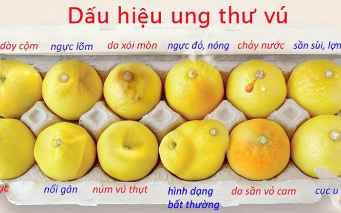 19 tuổi bàng hoàng nhận tin ung thư vú dù không đau, không ngứa, BS nói chi tiết này rất quan trọng khi tắm thường bị bỏ qua- Ảnh 5.