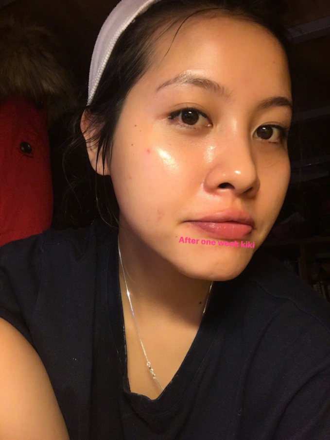 H&agrave;nh tr&igrave;nh thay đổi nhan sắc kh&ocirc;ng "dao k&eacute;o" của b&aacute;c sĩ da liễu: &Aacute;p dụng triệt để 1 c&aacute;ch l&agrave;m đẹp đang l&agrave; xu hướng thời đại mới!- Ảnh 4.