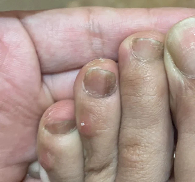 Bàn chân của người "giấu" ung thư thường có 5 khác biệt, chỉ mong bạn không đen đủi có cái nào!- Ảnh 3.