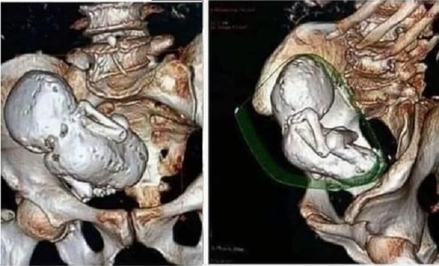 Chụp CT cho cụ bà 73 tuổi, bác sĩ sốc nặng khi phát hiện thai nhi hóa đá 30 năm- Ảnh 1.