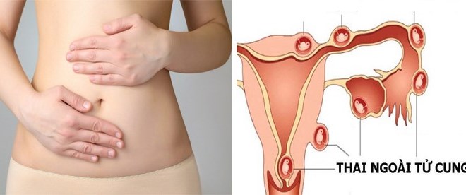 Nữ ca sĩ bị vỡ ống dẫn trứng do mang thai ngoài tử cung: "Vẫn uống thuốc giảm đau và bước ra sân khấu mà không biết nguy hiểm đang chờ"- Ảnh 3.