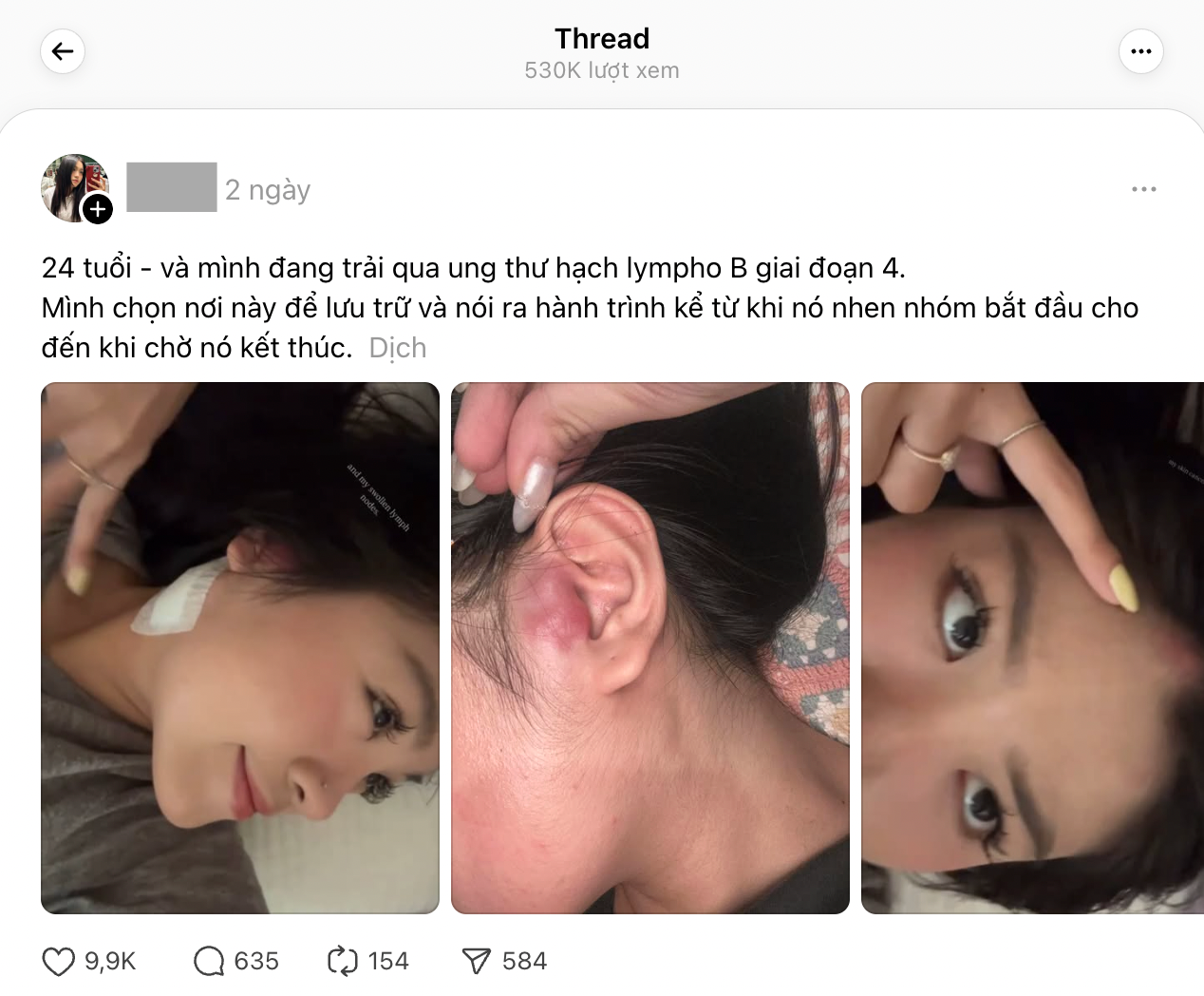 Cô gái TP.HCM 24 tuổi bị ung thư hạch giai đoạn 4: Bác sĩ nói lý do có thể đến từ... mọi thứ- Ảnh 2.