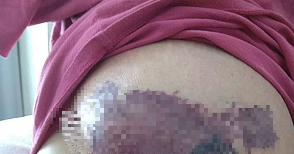 Người phụ nữ mới sinh ngực đột ngột chuyển màu đen, bác sĩ sốc nặng khi phát hiện "bí mật" đáng sợ- Ảnh 1.