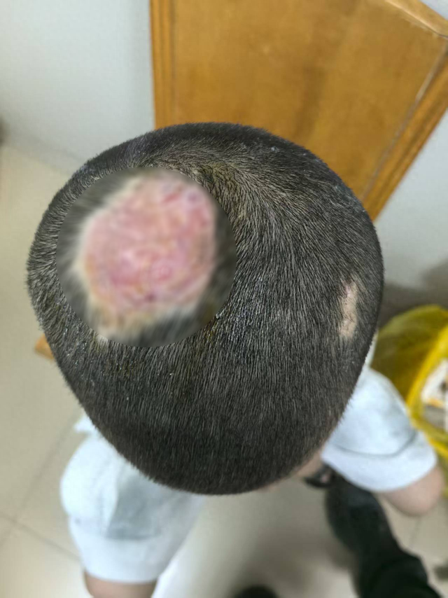 Cậu bé 6 tuổi hói vĩnh viễn vì nuôi thú cưng- Ảnh 1.