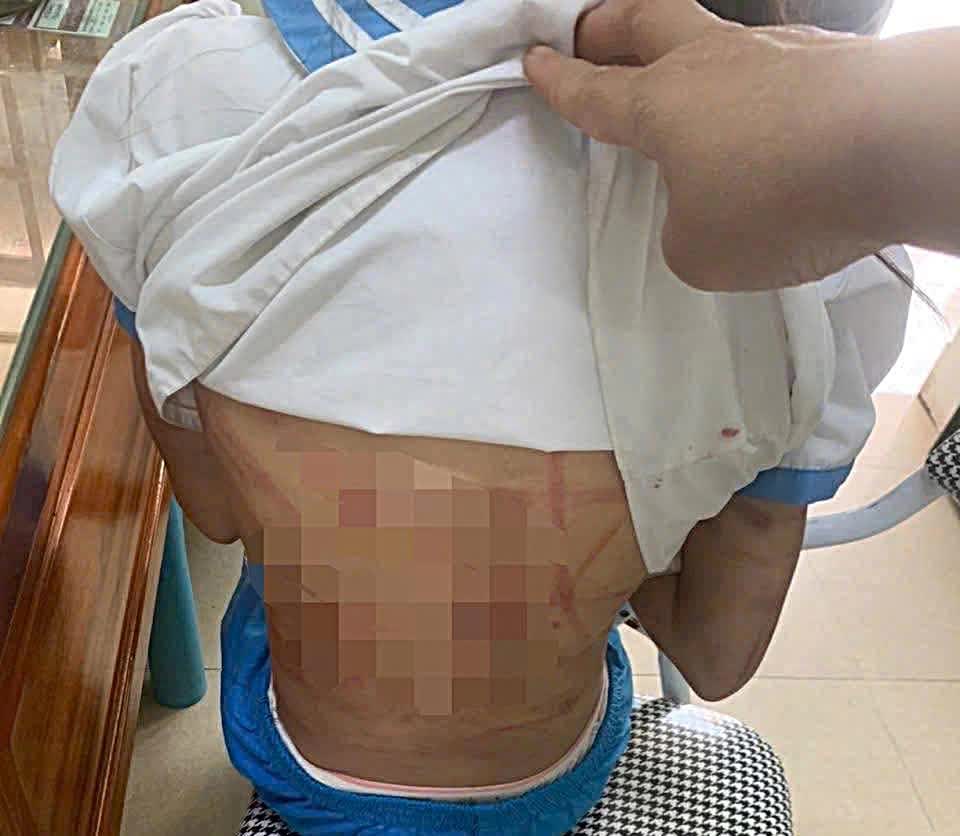 Vụ cha dượng dùng búa đinh bạo hành bé lớp 5: Hành vi tàn nhẫn!- Ảnh 2.