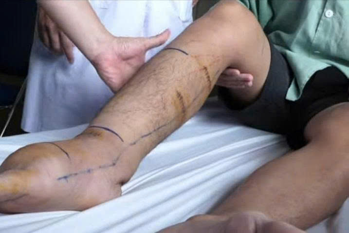 Chân to như "chân voi", nước tiểu trắng như sữa: Bác sĩ hé lộ 'thủ phạm' bất ngờ- Ảnh 1.