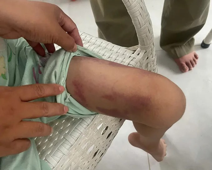 Bé gái 9 tuổi bị mẹ ruột cùng người tình đánh dã man trong phòng trọ- Ảnh 1.