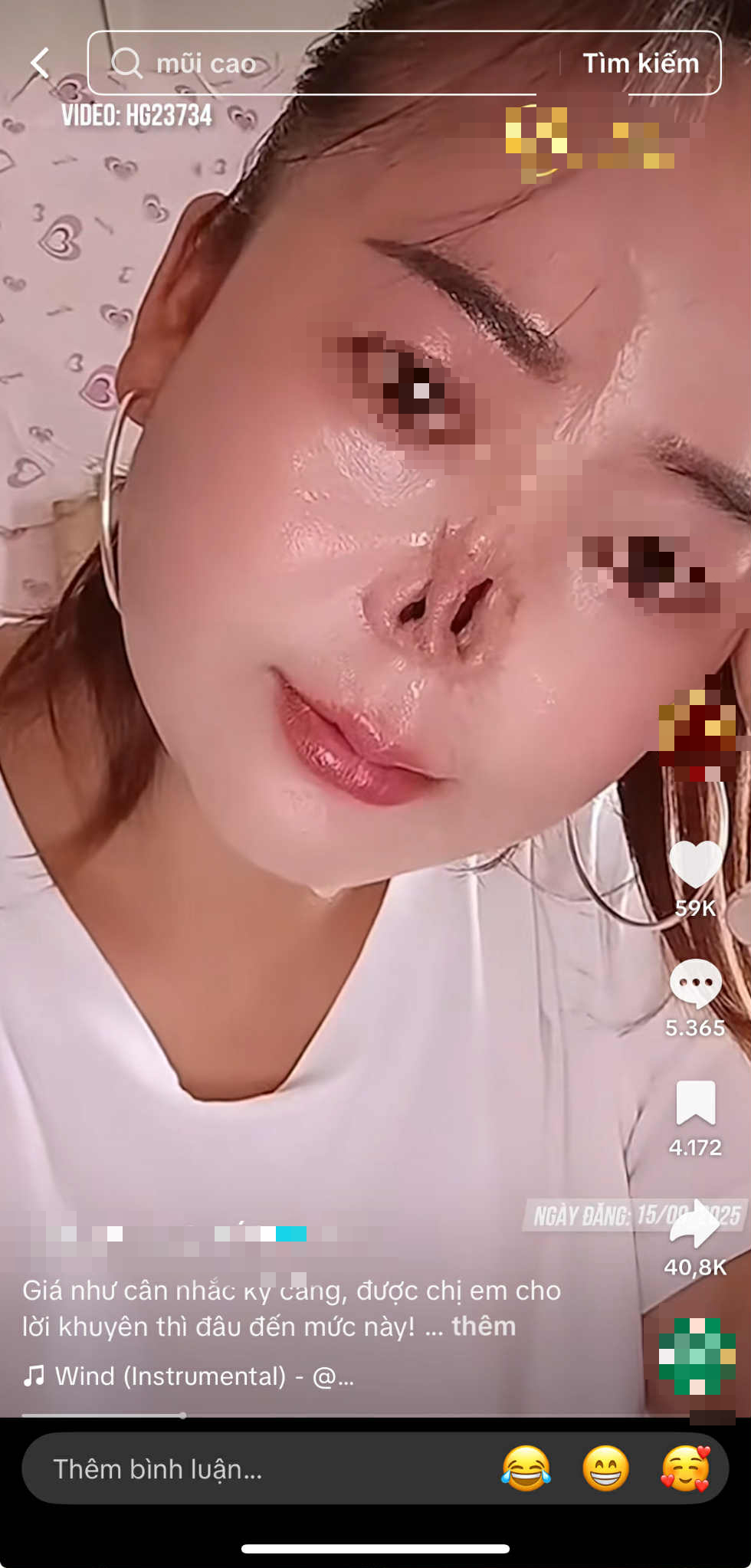 Đi sửa mũi cho thêm xinh, cô gái không ngờ mất luôn sống mũi: BS khuyến cáo 5 việc cần nhớ trước khi nâng mũi để tránh gặp họa- Ảnh 2.