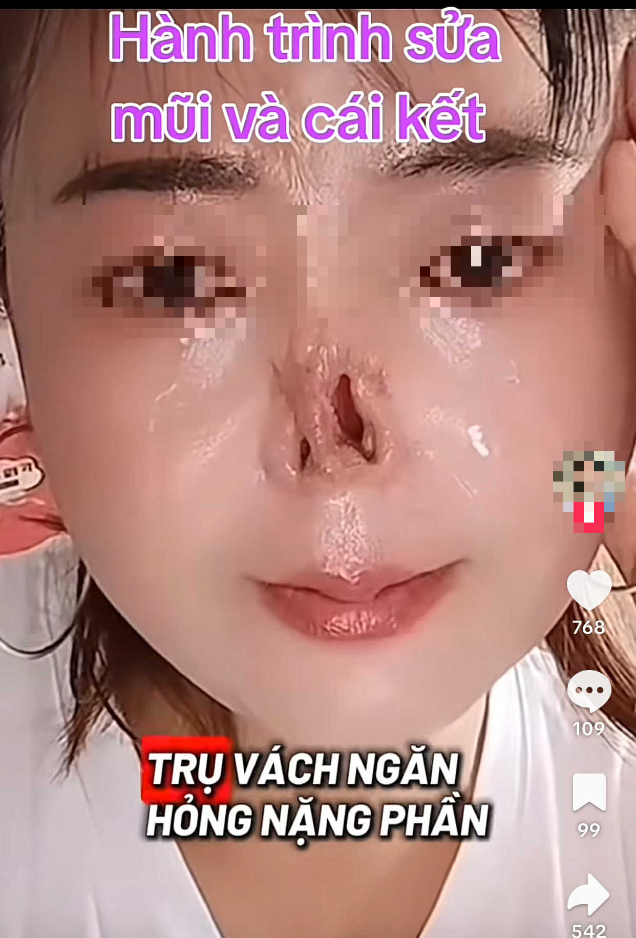 Đi sửa mũi cho thêm xinh, cô gái không ngờ mất luôn sống mũi: BS khuyến cáo 5 việc cần nhớ trước khi nâng mũi để tránh gặp họa- Ảnh 1.