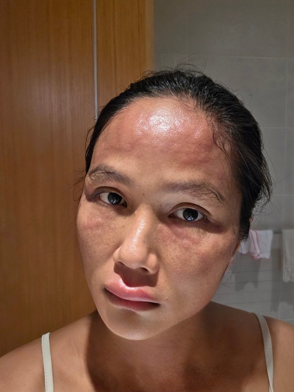 Hoa hậu H'Hen Niê sau khi bị biến dạng mặt- Ảnh 2. Hoa hậu H'Hen Niê sau khi bị biến dạng mặt- Ảnh 2.