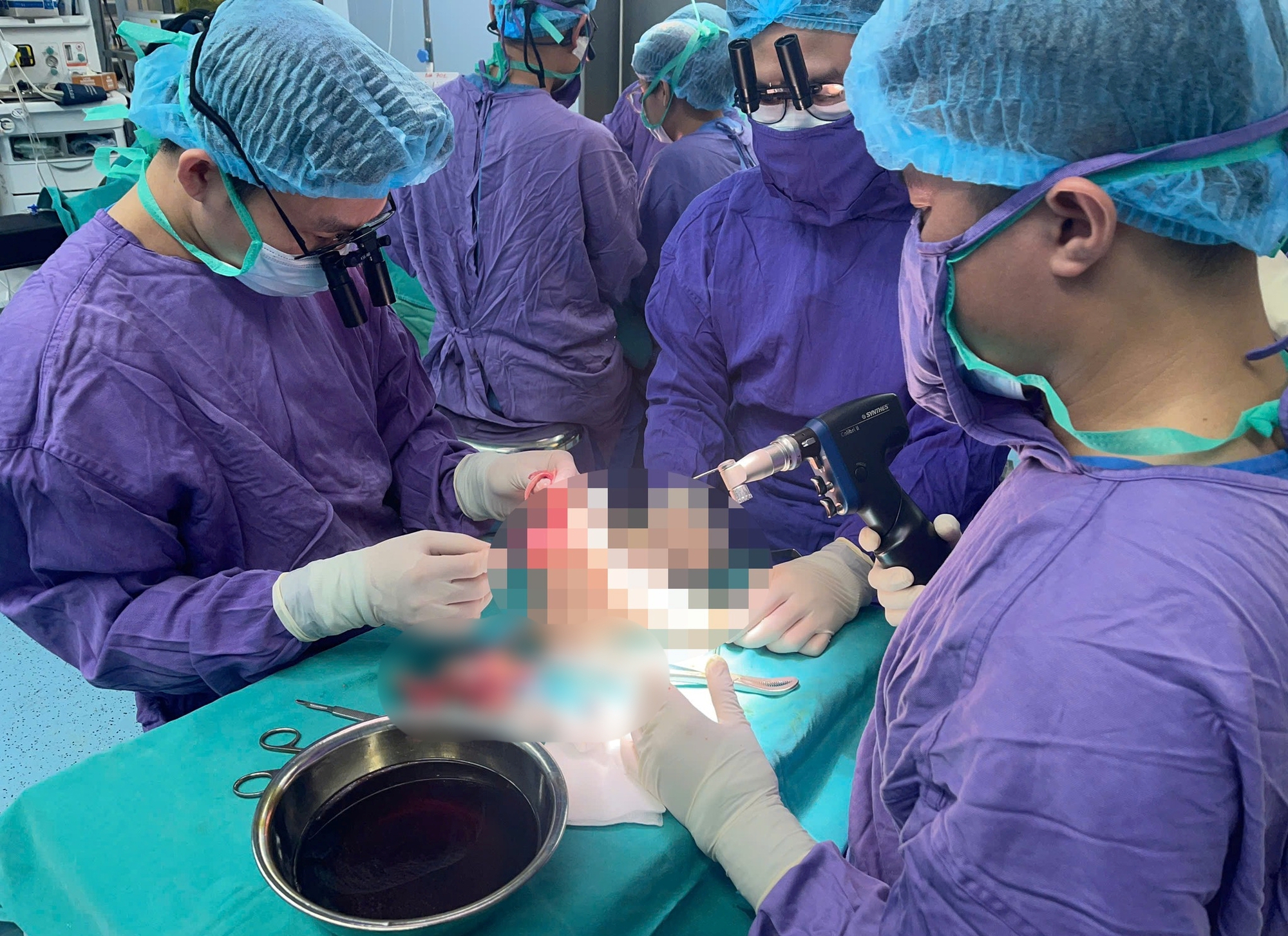 Kỳ tích 6 tiếng nối lại chân cho cô gái 19 tuổi sau tai nạn kinh hoàng với xe phân khối lớn ở Hà Nội- Ảnh 3.