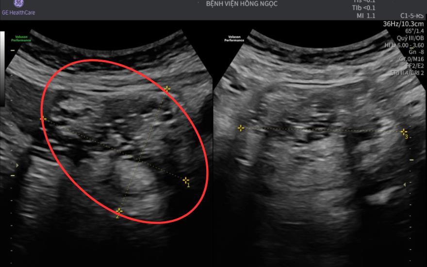 Phẫu thuật loại bỏ u quái buồng trứng chứa đầy tóc, xương và răng- Ảnh 2. Phẫu thuật loại bỏ u quái buồng trứng chứa đầy tóc, xương và răng- Ảnh 2.