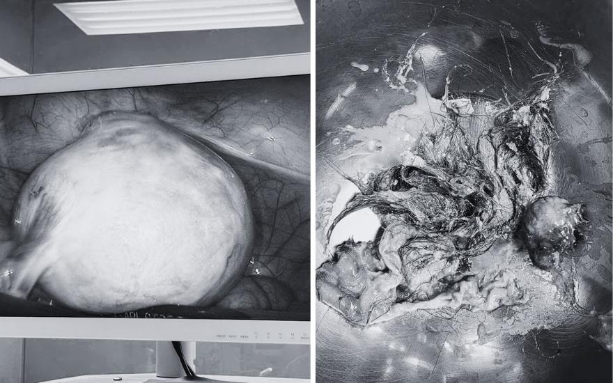 Phẫu thuật loại bỏ u quái buồng trứng chứa đầy tóc, xương và răng- Ảnh 3. Phẫu thuật loại bỏ u quái buồng trứng chứa đầy tóc, xương và răng- Ảnh 3.