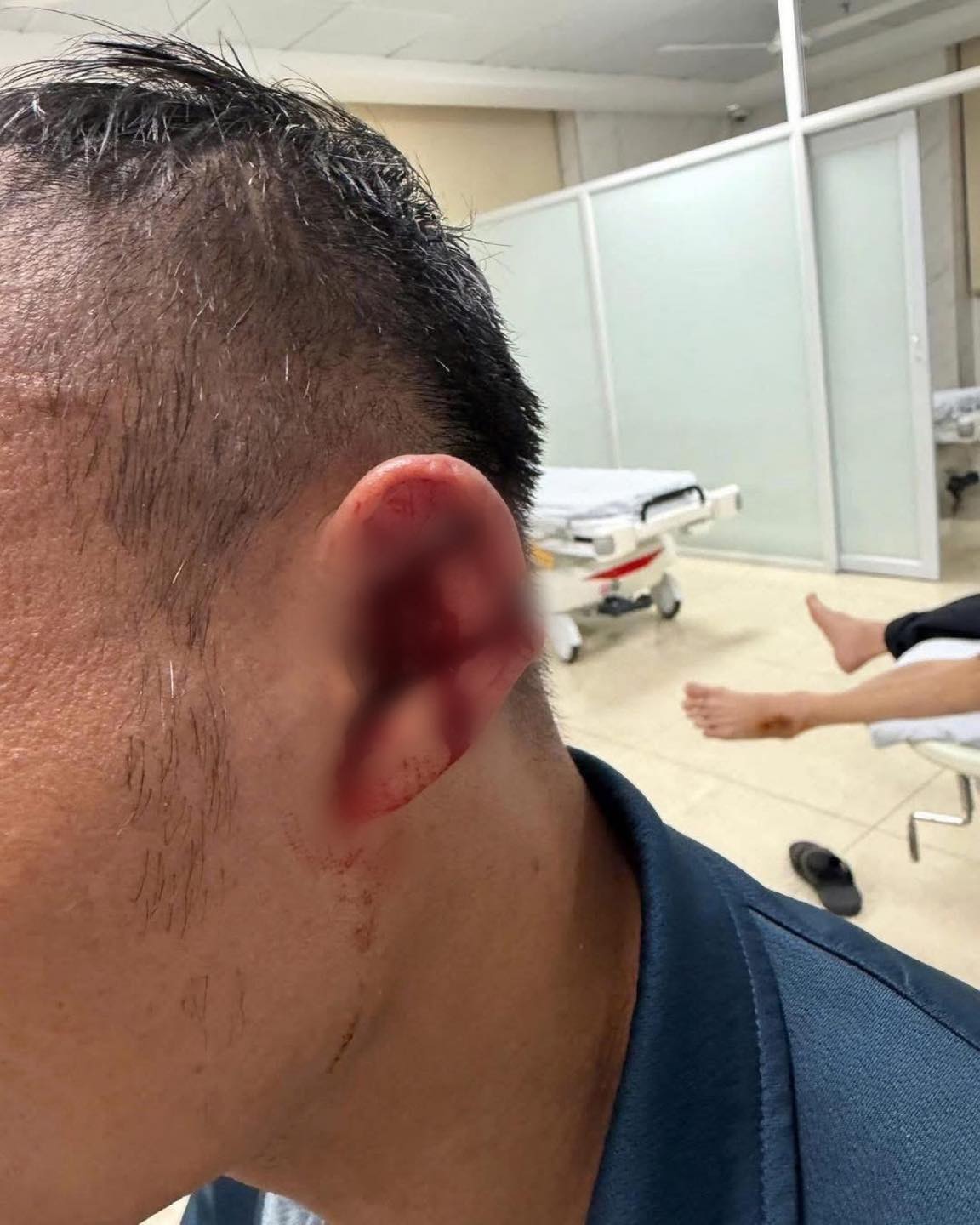 Trọng Hoàng bị Hoàng Hên giẫm rách tai ở V.League- Ảnh 1. Trọng Hoàng bị Hoàng Hên giẫm rách tai ở V.League- Ảnh 1.