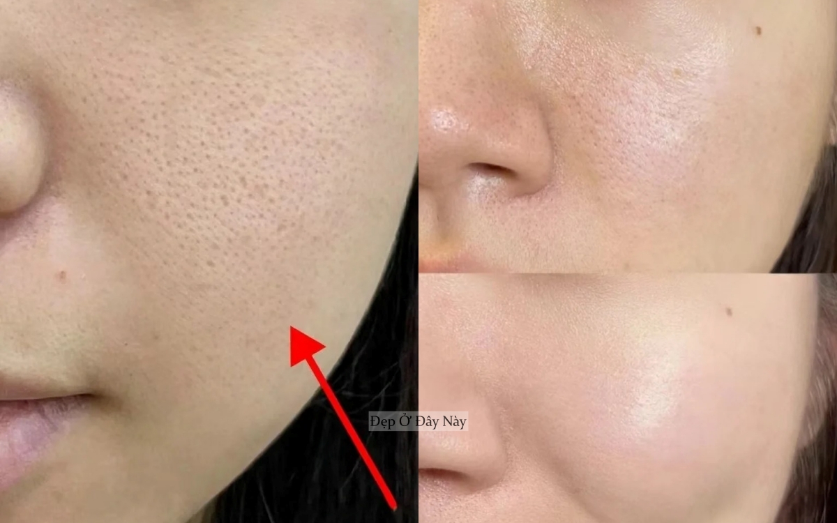 Ở tuổi 27, tôi đã tìm được "chân ái" trị da mụn, lỗ chân lông to- Ảnh 5.