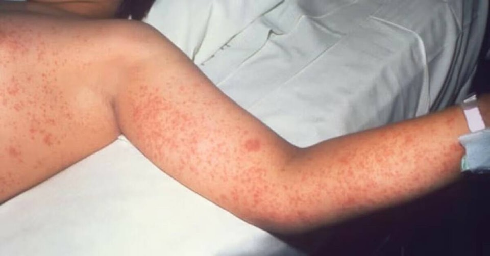 Canada mất trạng thái "loại trừ bệnh sởi" sau 3 thập kỷ- Ảnh 2.