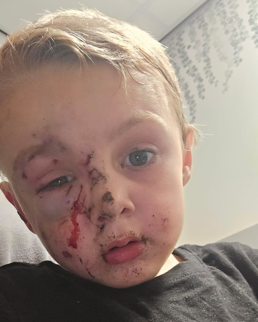 Bé trai 5 tuổi bị chó dữ tấn công khi đang đi dạo ở công viên- Ảnh 2.