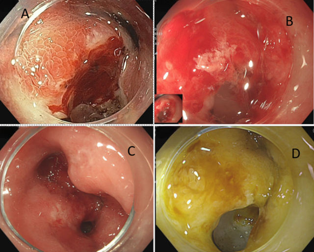 Bé trai 12 tuổi xuất huyết tiêu hóa, 3 tháng nhập viện 2 lần vì loại vi khuẩn 70% dân số Việt Nam nhiễm- Ảnh 1.
