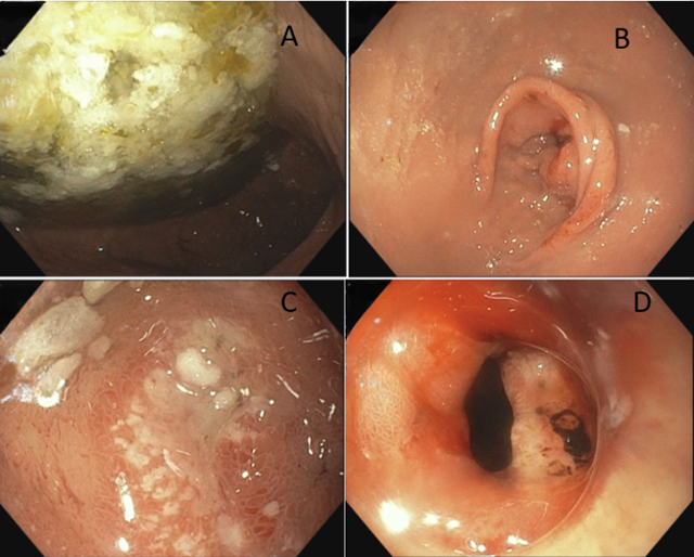 Bé trai 12 tuổi xuất huyết tiêu hóa, 3 tháng nhập viện 2 lần vì loại vi khuẩn 70% dân số Việt Nam nhiễm- Ảnh 2.