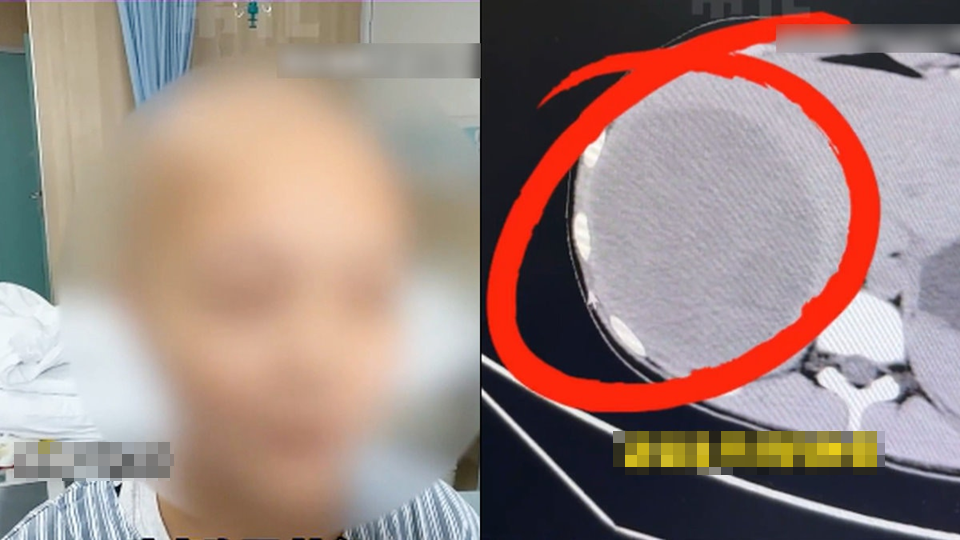 Bé gái 15 tuổi phát hiện khối u to bằng nửa lá gan, bác sĩ tức giận: Ai lại coi món này là bữa chính!- Ảnh 1.