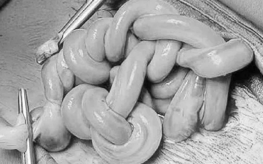 "Tết tóc" bằng dây rốn trong bụng mẹ và cuộc giải cứu hai bé song thai ở tuần 30- Ảnh 1.