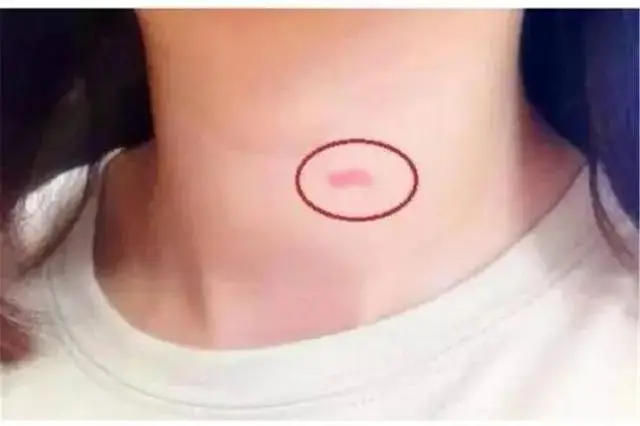 Thấy con gái 14 tuổi có "dấu vết lạ" trên cổ, hành động của người mẹ sau đó khiến dân mạng thán phục- Ảnh 2. Thấy con gái 14 tuổi có "dấu vết lạ" trên cổ, hành động của người mẹ sau đó khiến dân mạng thán phục- Ảnh 2.