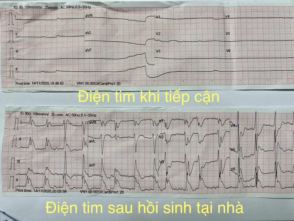 Người đàn ông 52 tuổi không qua khỏi vì người nhà dùng mẹo vắt chanh vào miệng khi hôn mê- Ảnh 2. Người đàn ông 52 tuổi không qua khỏi vì người nhà dùng mẹo vắt chanh vào miệng khi hôn mê- Ảnh 2.