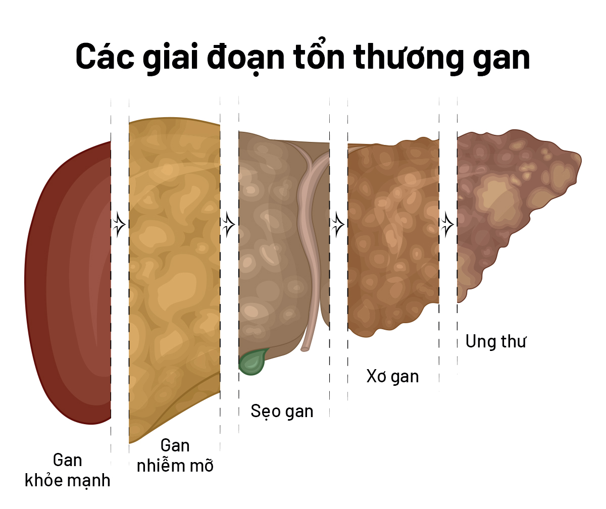 3 dấu hiệu sớm của ung thư gan nhưng dễ bị bỏ qua nhất- Ảnh 3.