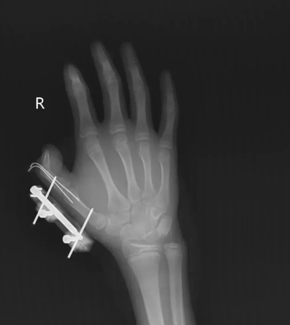 Mở tủ lạnh, bé gái 14 tuổi suýt mất ngón tay cái- Ảnh 1.