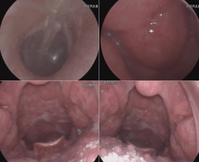 Chàng trai 22 tuổi viêm họng chảy máu vì quan hệ không an toàn- Ảnh 1.