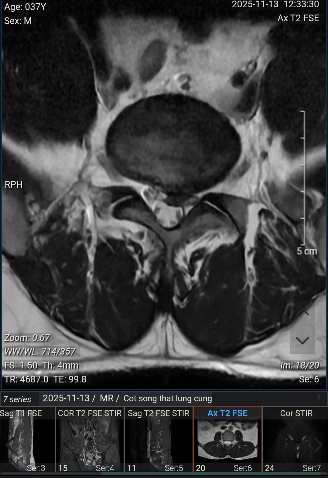 Người đàn ông 37 tuổi ở Hà Nội "nhận kết đắng" sau trận pickleball- Ảnh 1.