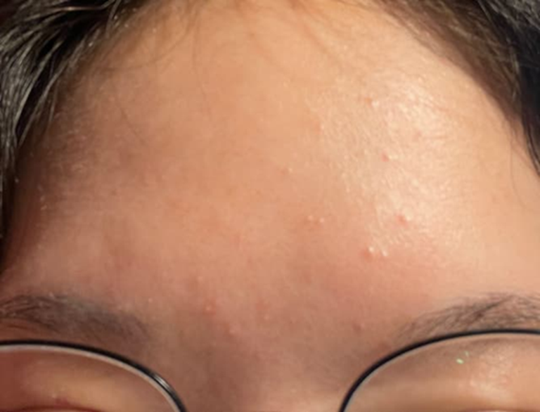 Con gái mọc mụn trứng cá, mẹ xin nghỉ phép đưa con đi cấp cứu- Ảnh 1.