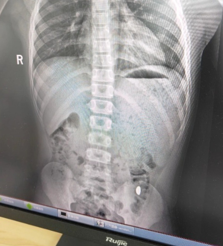 500.000 người theo dõi vụ cậu bé 11 tuổi nuốt nhầm miếng vàng 10g- Ảnh 2.