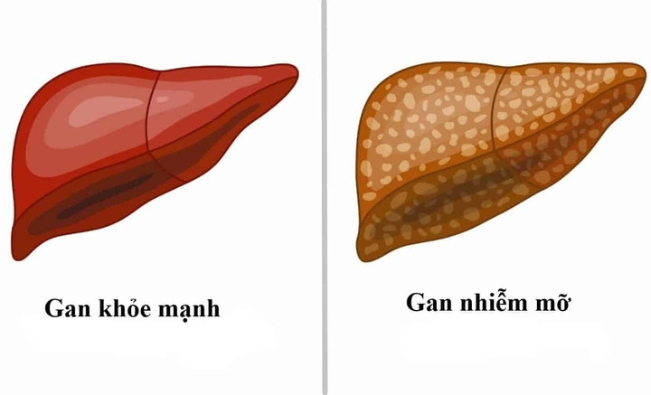 Người bị xơ gan, gan nhiễm mỡ do rượu bao lâu nên khám một lần?- Ảnh 1.
