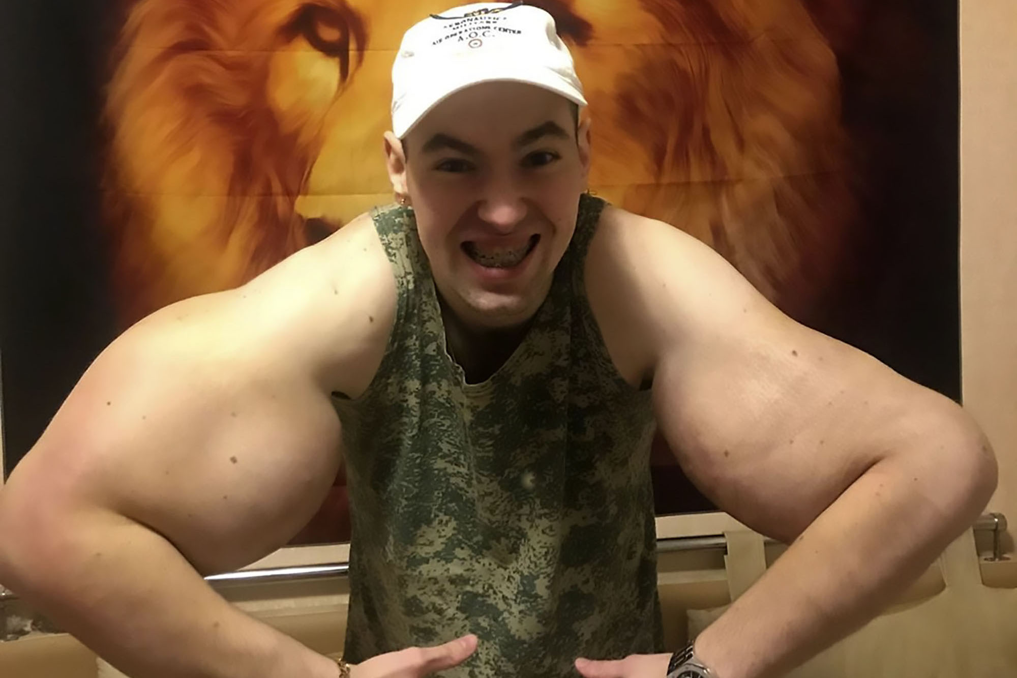 Tiêm chất làm phồng cơ bắp đến dị dạng, 