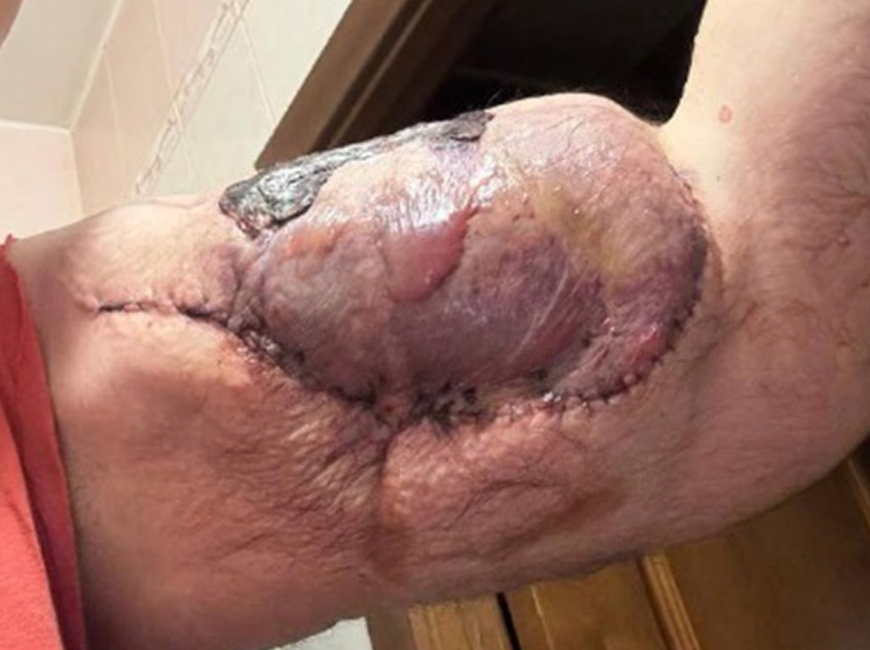 Tiêm chất làm phồng cơ bắp đến dị dạng, 