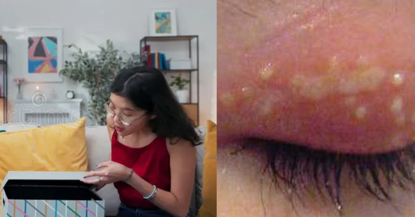Cô gái 27 tuổi nhiễm virus Herpes sau khi mở gói hàng mua qua mạng