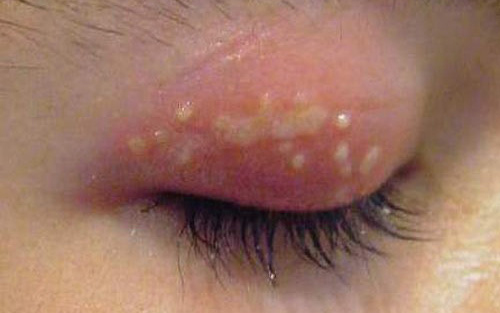 Cô gái 27 tuổi nhiễm virus Herpes sau khi mở gói hàng mua qua mạng- Ảnh 2.