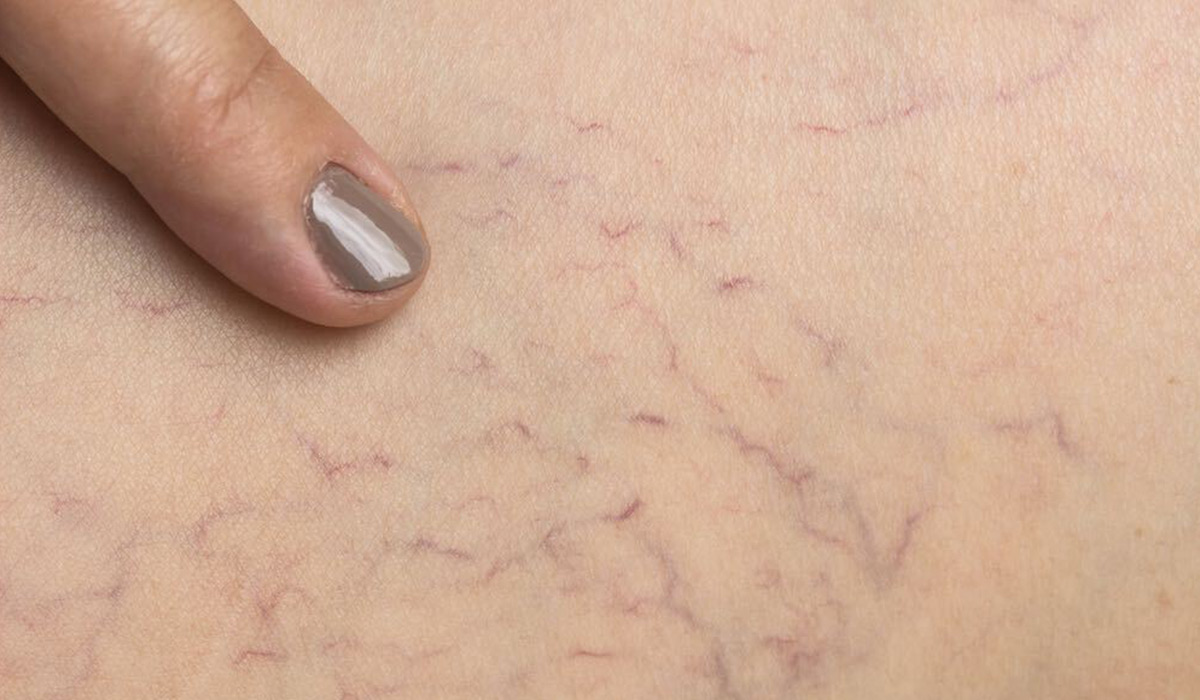 Nhìn tay và chân cũng có thể biết gan bị tổn thương hay không: Đây là 5 dấu hiệu cần lưu ý- Ảnh 4.