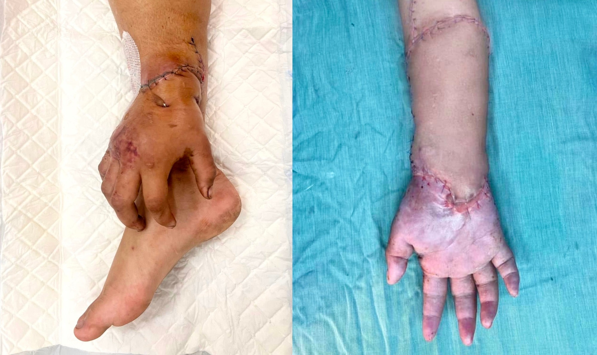 Bàn tay đứt lìa của mẹ bầu được nối lại sau thời gian 'nuôi' ở chân