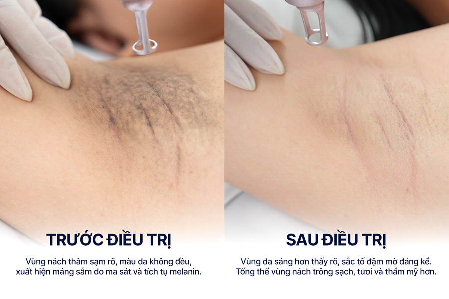 Sự thật về laser trị thâm: Điều bạn cần biết trước khi điều trị- Ảnh 3.
