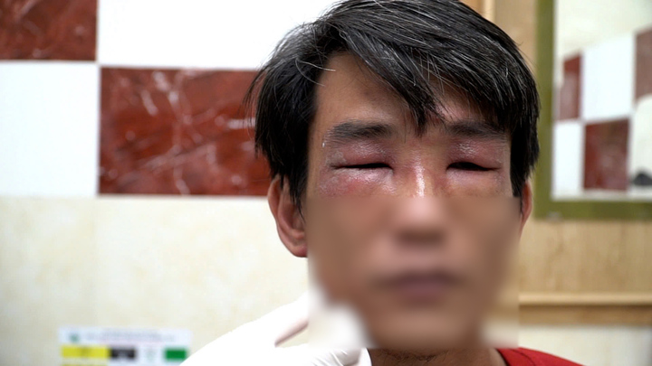 Kiến ba khoang lại tấn công người TP.HCM, bác sĩ cảnh báo chữa trị bằng 'mẹo'- Ảnh 1.