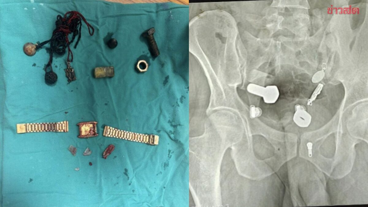 Người đàn ông liên tục đau bụng, bác sĩ sốc nặng khi phát hiện "bí mật" đáng sợ- Ảnh 2.