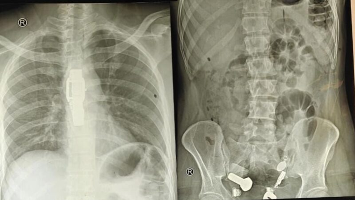 Người đàn ông liên tục đau bụng, bác sĩ sốc nặng khi phát hiện "bí mật" đáng sợ- Ảnh 1.