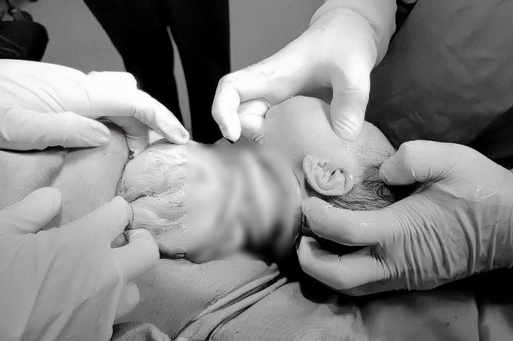 Bé gái chào đời với 6 vòng dây rốn quấn cổ, mẹ tiền sản giật- Ảnh 1.